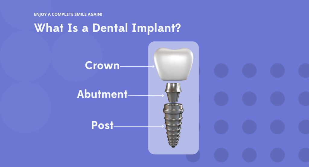 Diagram shows the structure of a dental implant similar to our custom dental implants in Redding and Red Bluff.